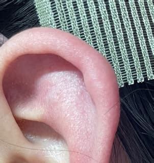 耳洞發炎腫起來 粉色